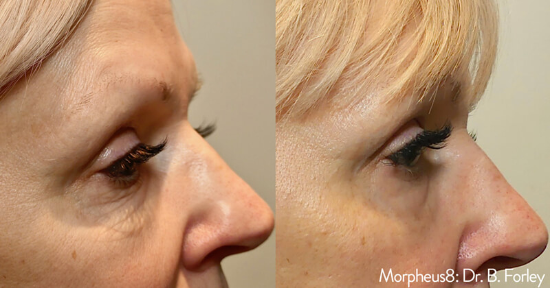 before-and-after-oxygeneo-reduces-crows-feet-on-middle-aged-woman
