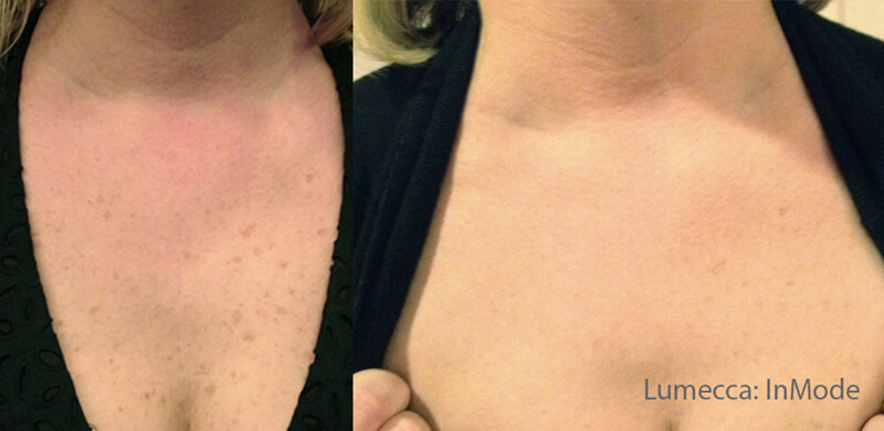 before-and-after-oxygeneo-evens-skin-pigmentation-on-womans-chest