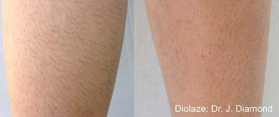 light blue body hair removal