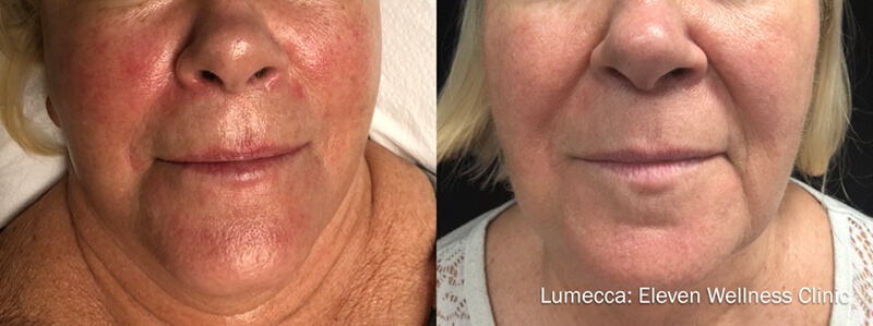 before-and-after-oxygeneo-reduces-redness-on-womans-face