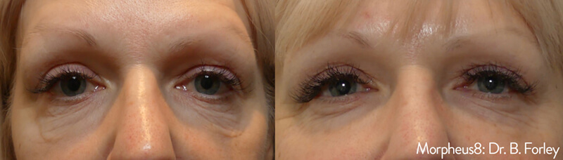 before-and-after-oxygeneo-reduces-wrinkles-around-womans-eyes